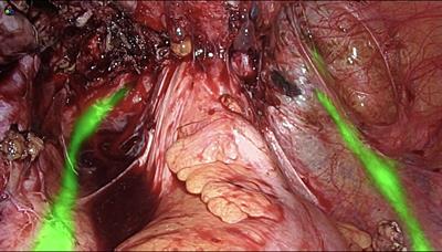 Surgeons' workload assessment during indocyanine-assisted deep endometriosis surgery using the surgery task load index: The impact of the learning curve